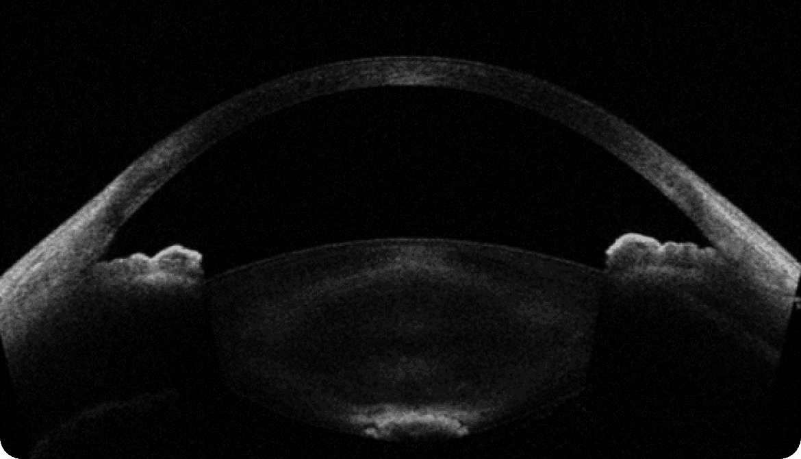 Posterior Subcapsular Cataract Case Photos