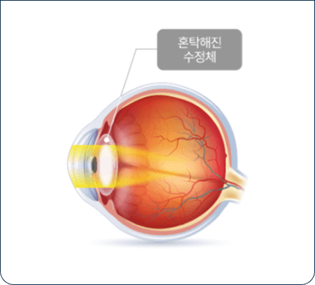 백내장이 있는 눈