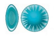 Cortical Cataract