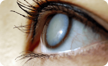 Pupil Opacity