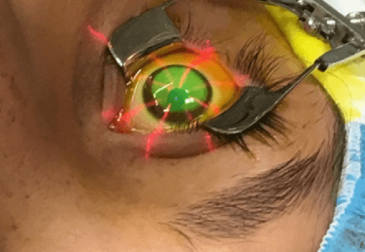 Corneal Cross-Linking (CXL)