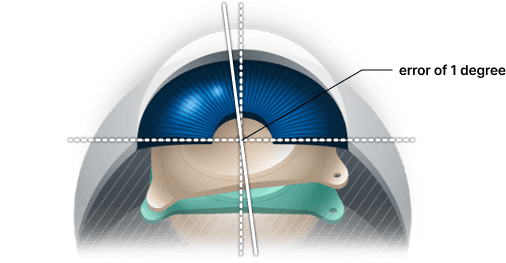 Accurate lens insertion angle