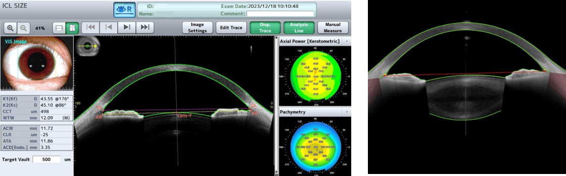 Anterior Segment OCT Equipment