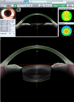 Anterior Segment OCT Equipment
