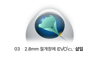 수술과정 3