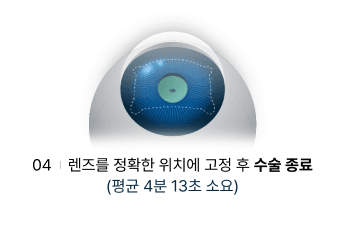 수술과정 4